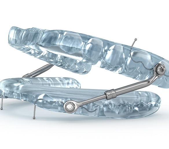 Generic image of an oral appliance for sleep apnea